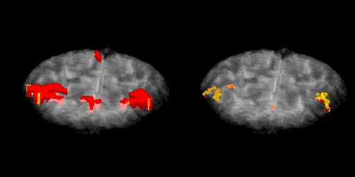A functional MRI scan showing areas of the brain activating
